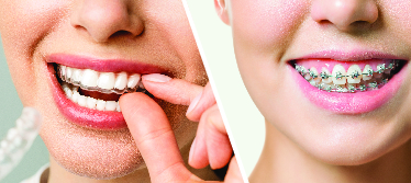 Braces vs Clear Aligners