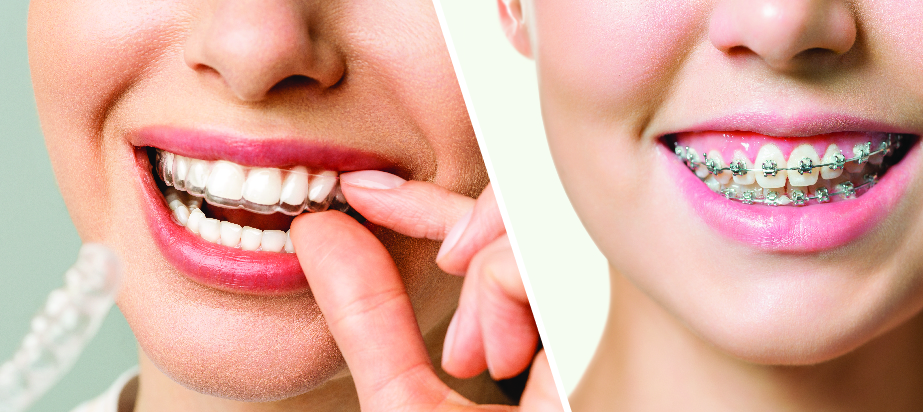 Aligners vs Braces: Which Is Better for Straightening Teeth? Braces vs Clear Aligners