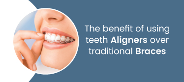 The benefit of using teeth aligners over traditional braces