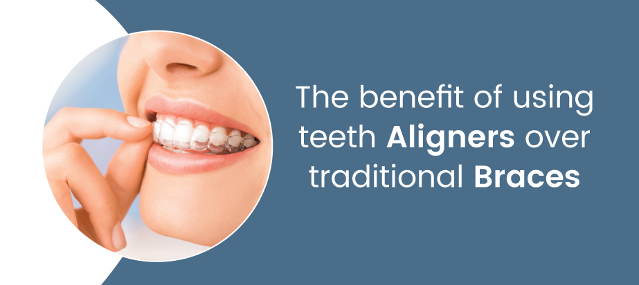 Benefits of Teeth Aligners Over Traditional Braces The benefit of using teeth aligners over traditional braces
