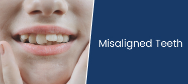 Misaligned Teeth - Causes, Treatments, and Why Teeth Aligners Are Best