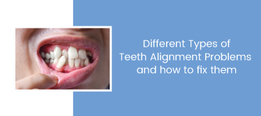 Different Types of Teeth Alignment Problems and how to fix them
