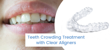 Teeth Crowding Treatment with Clear Aligners - Regain your Confident Smile
