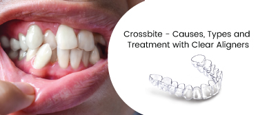 Crossbite - Causes, Types and Treatment with Clear Aligners