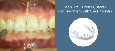 Deep Bite - Causes, Effects, and Treatment with Clear Aligners